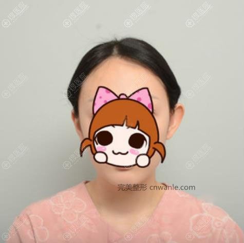 韓國(guó)普羅菲耳招風(fēng)耳矯正真人案例