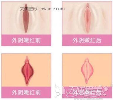 杭州時光陰唇漂紅手術