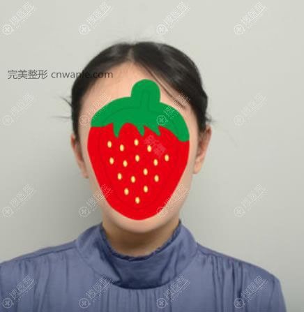 韓國(guó)普羅菲耳招風(fēng)耳整形術(shù)后2周恢復(fù)效果