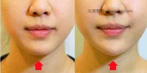 玻尿酸<a href='/tag_dianxiabaduoshao.html'>墊下巴多少錢(qián)</a>一針要幾支才定型？玻尿酸墊下巴多久恢復(fù)自然