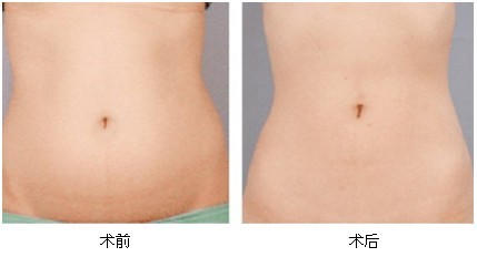 <a href='/tag_xizhishu3.html'>吸脂術</a>