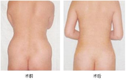 吸脂術